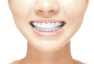 Woman smiling with ceramic braces