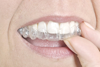 Placing an invisalign brace over teeth